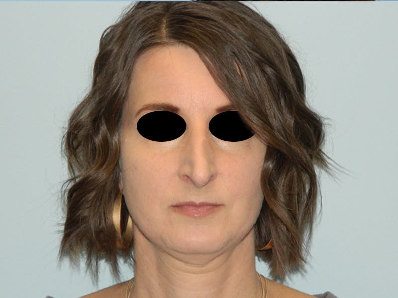 Rhinoplasty Before & After Gallery - Patient 133066496 - Image 11