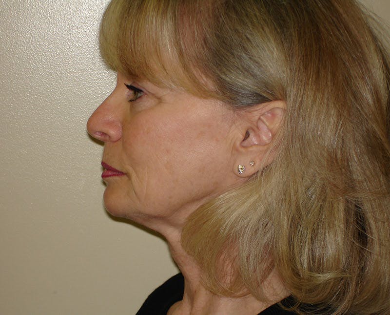 Mini-Facelift Before & After Gallery - Patient 133066492 - Image 3