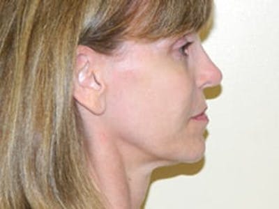 Ultherapy Before & After Gallery - Patient 133066484 - Image 1