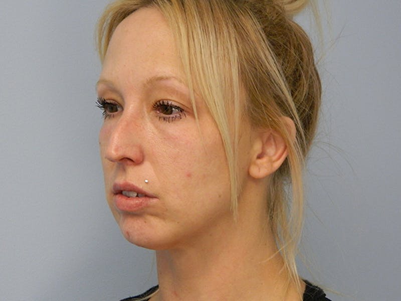 Non-Surgical Rhinoplasty and Injectable Fillers Before & After Gallery - Patient 133066489 - Image 3