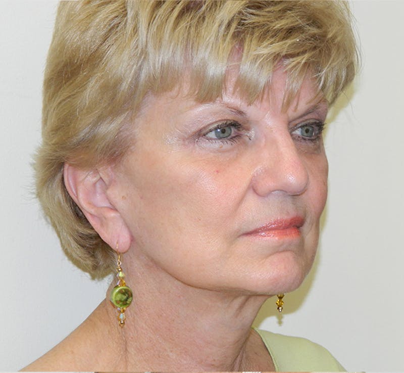 Blepharoplasty (Eyelid Lift) Before & After Gallery - Patient 133066487 - Image 6