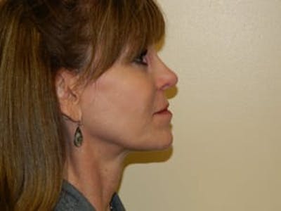 Ultherapy Before & After Gallery - Patient 133066484 - Image 2