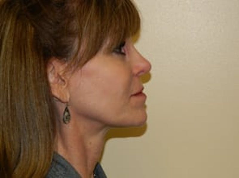 Ultherapy Before & After Gallery - Patient 133066484 - Image 2