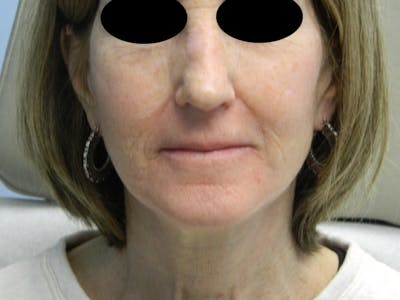 Fraxel Laser Resurfacing Before & After Gallery - Patient 133066488 - Image 2
