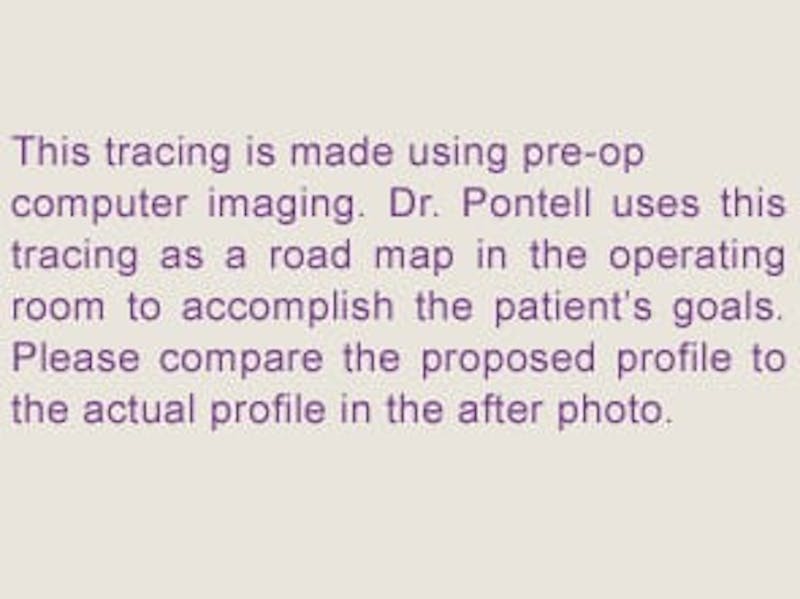 Facelift Before & After Gallery - Patient 133066485 - Image 6