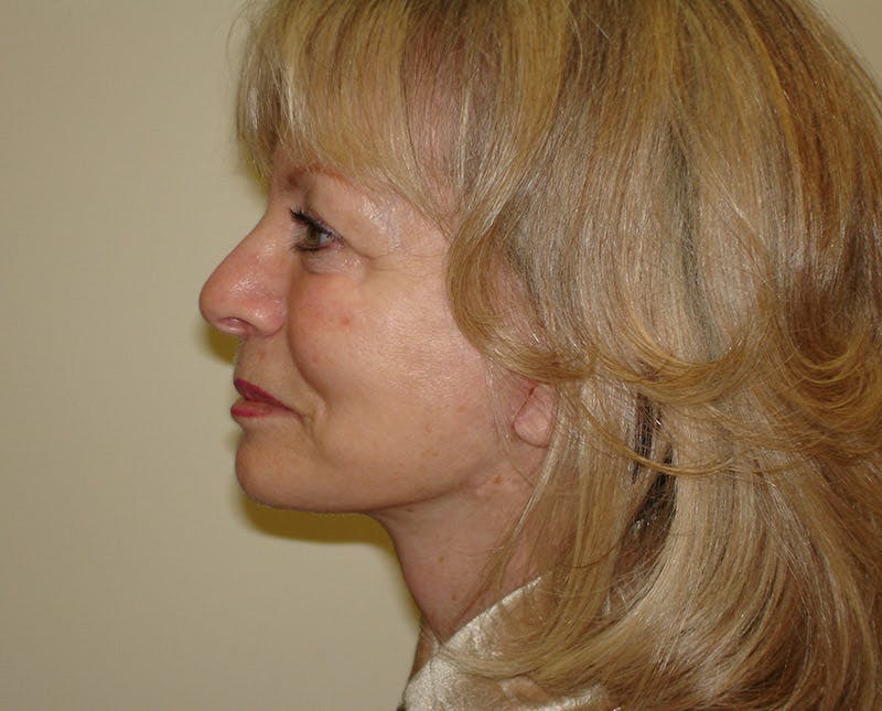 Mini-Facelift Before & After Gallery - Patient 133066492 - Image 4