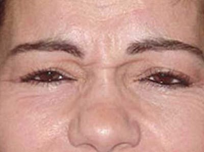 Botox Before & After Gallery - Patient 133066491 - Image 1