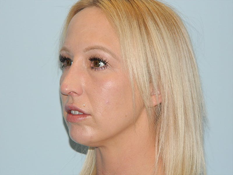 Non-Surgical Rhinoplasty and Injectable Fillers Before & After Gallery - Patient 133066489 - Image 4