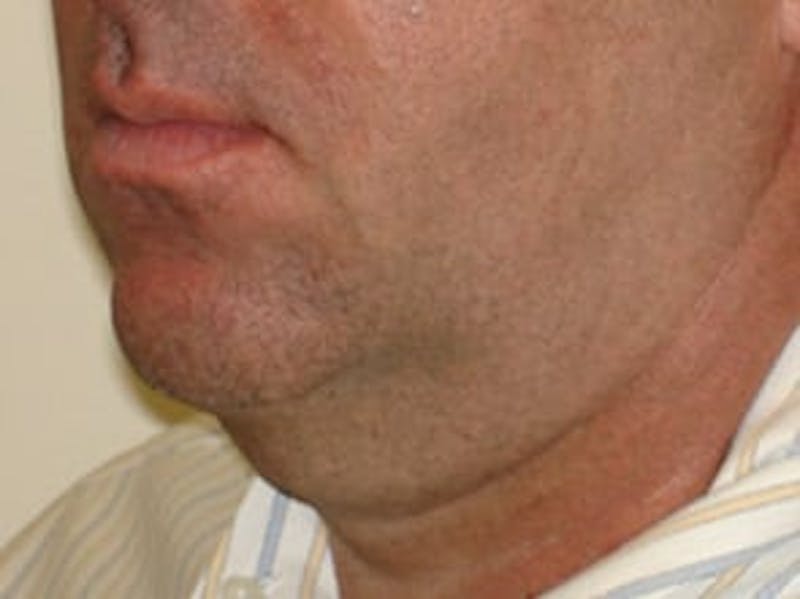 Ultherapy Before & After Gallery - Patient 133066490 - Image 1