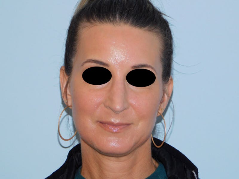 Rhinoplasty Before & After Gallery - Patient 133066496 - Image 12