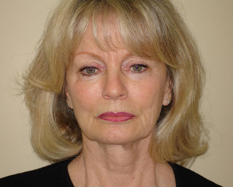Mini-Facelift Before & After Gallery - Patient 133066492 - Image 5