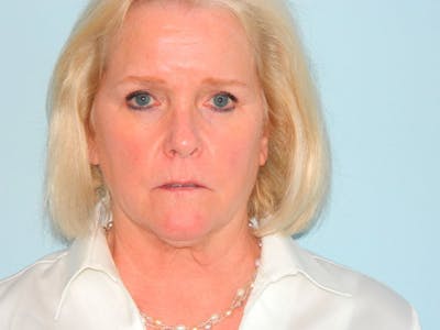 Facelift Before & After Gallery - Patient 133066501 - Image 1