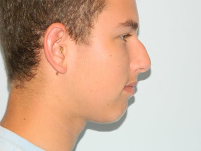 Chin Augmentation Before & After Gallery - Patient 133066499 - Image 1
