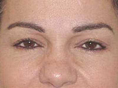 Botox Before & After Gallery - Patient 133066491 - Image 2