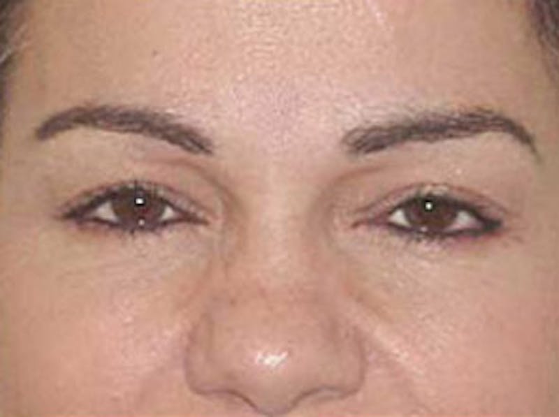 Botox Before & After Gallery - Patient 133066491 - Image 2