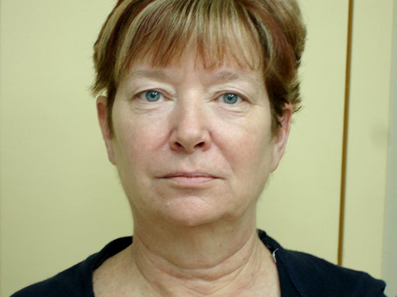 Blepharoplasty (Eyelid Lift) Before & After Gallery - Patient 133066498 - Image 1