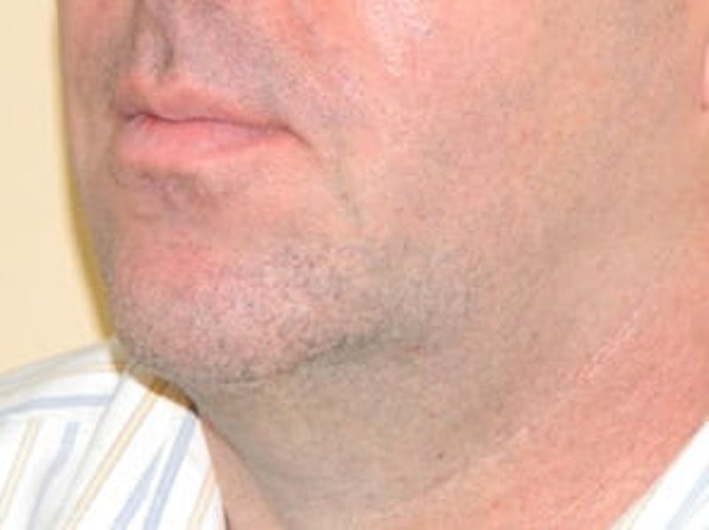 Ultherapy Before & After Gallery - Patient 133066490 - Image 2