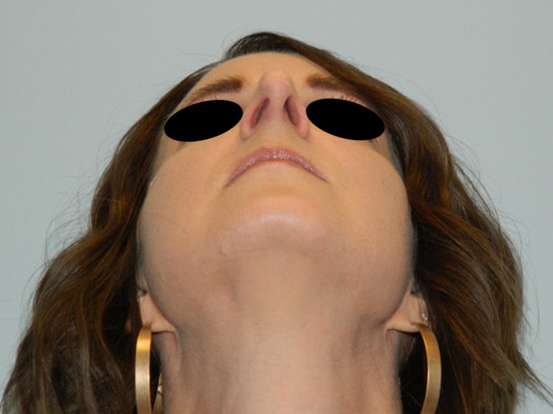 Rhinoplasty Before & After Gallery - Patient 133066496 - Image 13
