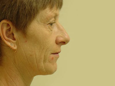 Fraxel Laser Resurfacing Before & After Gallery - Patient 133066493 - Image 1