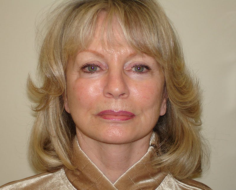 Mini-Facelift Before & After Gallery - Patient 133066492 - Image 6