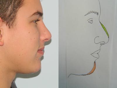 Chin Augmentation Before & After Gallery - Patient 133066499 - Image 2