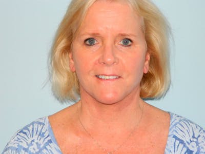 Facelift Before & After Gallery - Patient 133066501 - Image 2