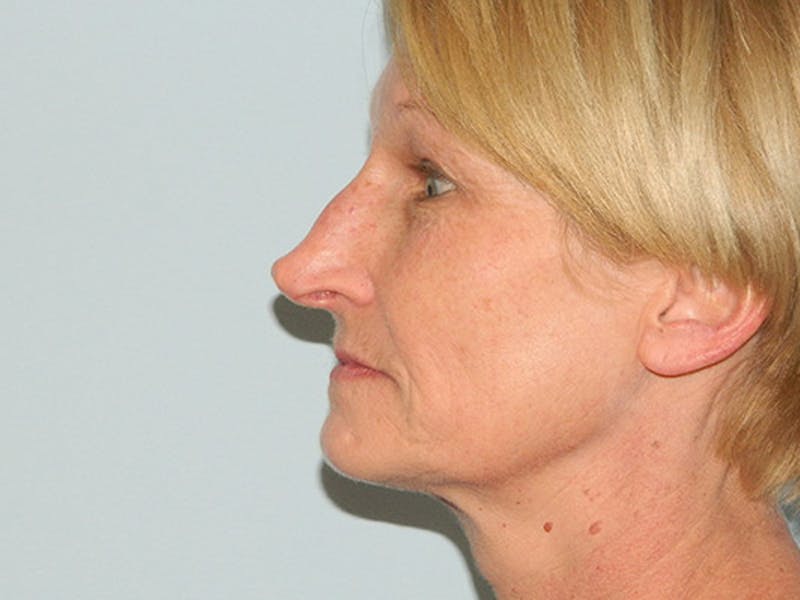 Non-Surgical Rhinoplasty and Injectable Fillers Before & After Gallery - Patient 133066497 - Image 1