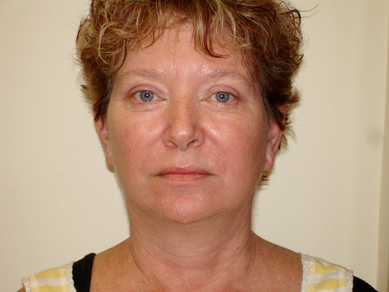 Blepharoplasty (Eyelid Lift) Before & After Gallery - Patient 133066498 - Image 2