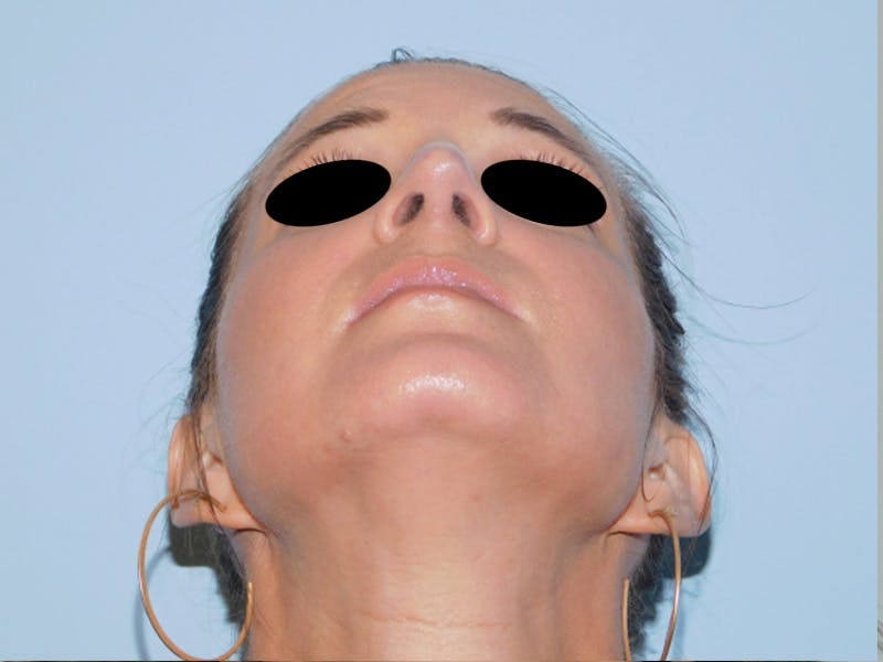 Rhinoplasty Before & After Gallery - Patient 133066496 - Image 14