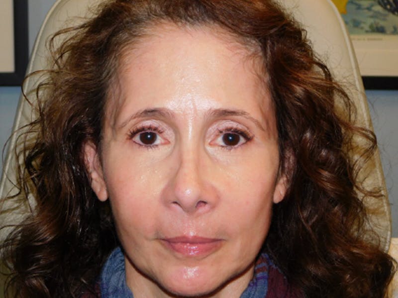 Ultherapy Before & After Gallery - Patient 133066494 - Image 1