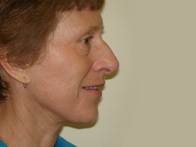 Fraxel Laser Resurfacing Before & After Gallery - Patient 133066493 - Image 2