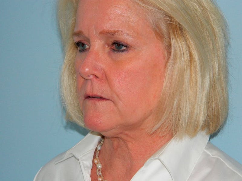 Facelift Before & After Gallery - Patient 133066501 - Image 3