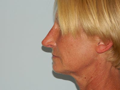 Non-Surgical Rhinoplasty and Injectable Fillers Before & After Gallery - Patient 133066497 - Image 2