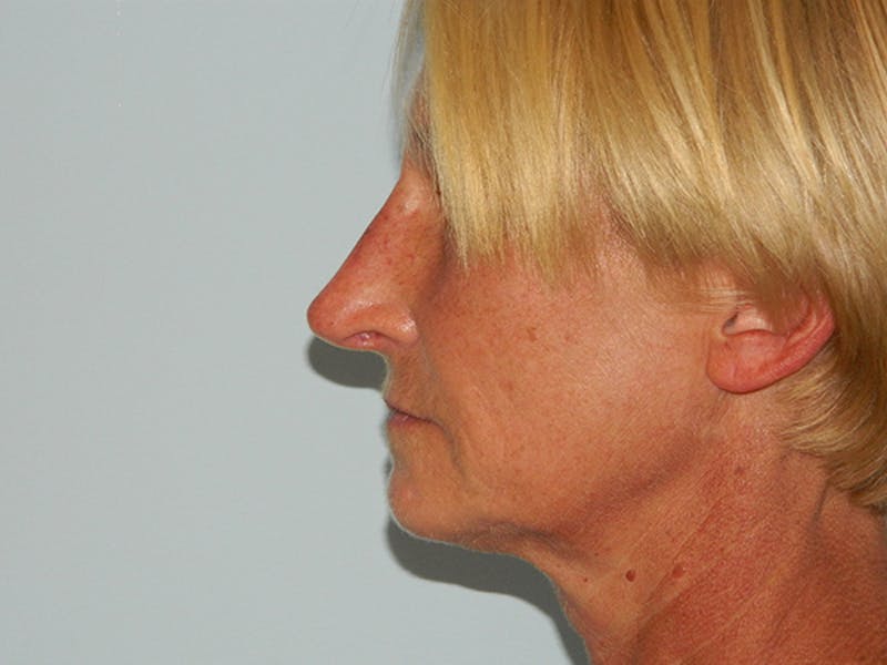 Non-Surgical Rhinoplasty and Injectable Fillers Before & After Gallery - Patient 133066497 - Image 2