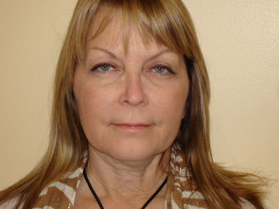 Mini-Facelift Before & After Gallery - Patient 133066505 - Image 1