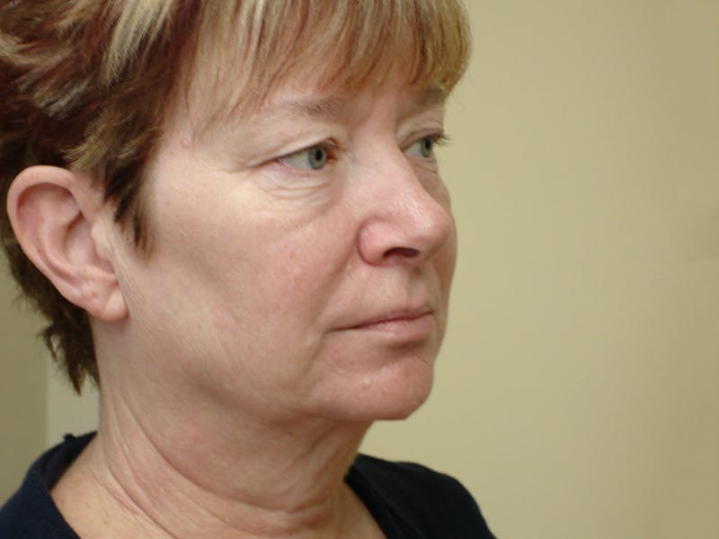 Blepharoplasty (Eyelid Lift) Before & After Gallery - Patient 133066498 - Image 3