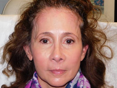 Ultherapy Before & After Gallery - Patient 133066494 - Image 2