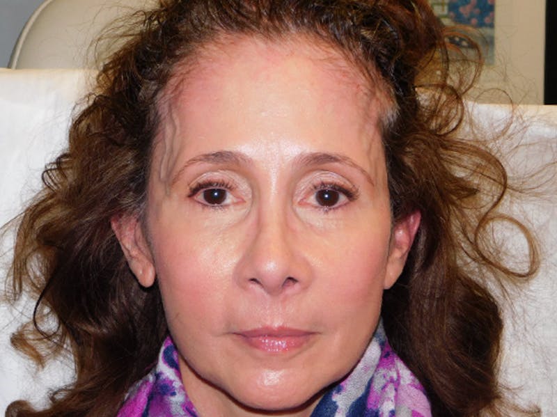 Ultherapy Before & After Gallery - Patient 133066494 - Image 2