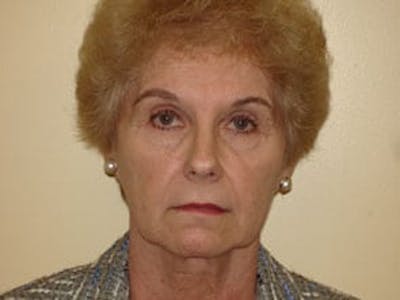 Fraxel Laser Resurfacing Before & After Gallery - Patient 133066500 - Image 1