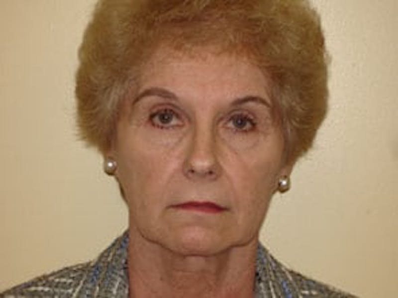 Fraxel Laser Resurfacing Before & After Gallery - Patient 133066500 - Image 1