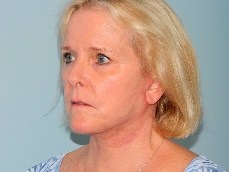 Facelift Before & After Gallery - Patient 133066501 - Image 4