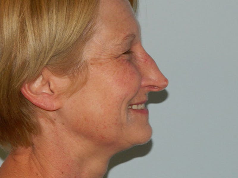 Non-Surgical Rhinoplasty and Injectable Fillers Before & After Gallery - Patient 133066497 - Image 3