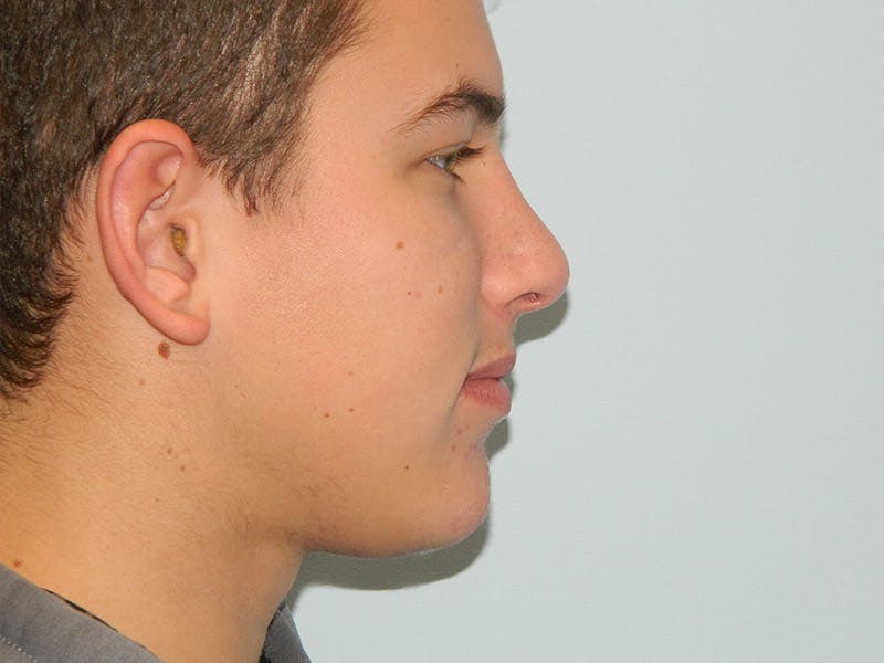 Chin Augmentation Before & After Gallery - Patient 133066499 - Image 4