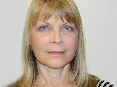 Mini-Facelift Before & After Gallery - Patient 133066505 - Image 2