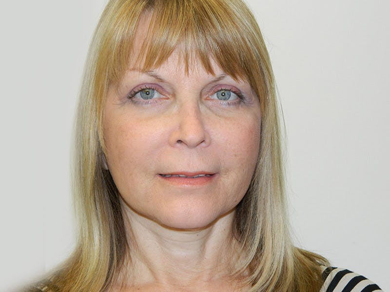 Mini-Facelift Before & After Gallery - Patient 133066505 - Image 2