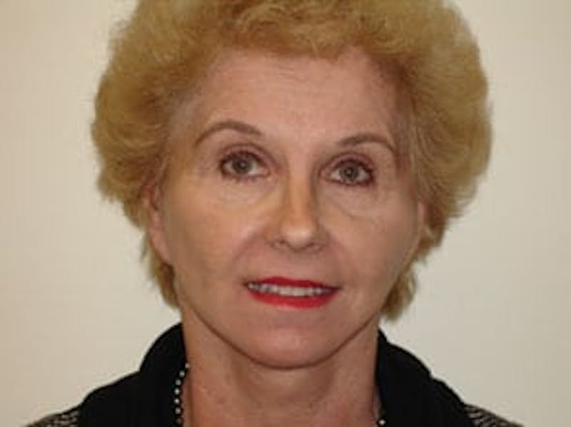 Fraxel Laser Resurfacing Before & After Gallery - Patient 133066500 - Image 2