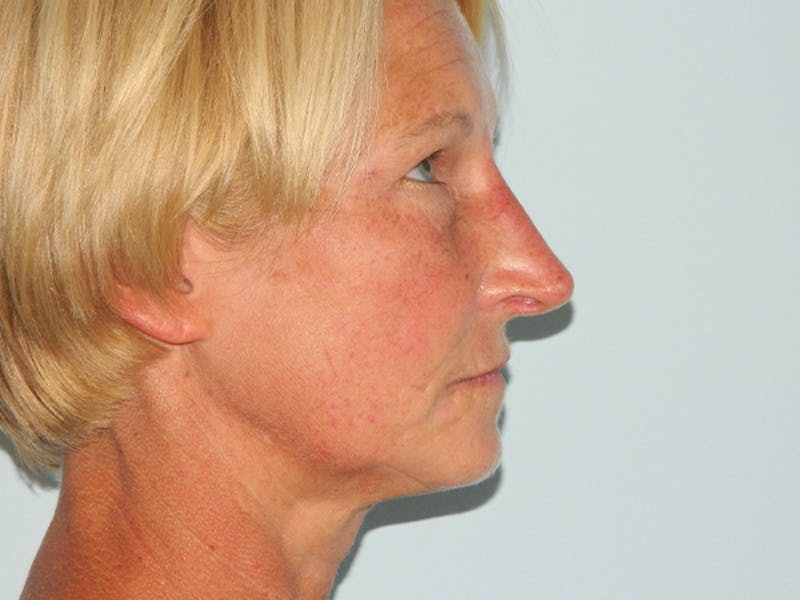 Non-Surgical Rhinoplasty and Injectable Fillers Before & After Gallery - Patient 133066497 - Image 4