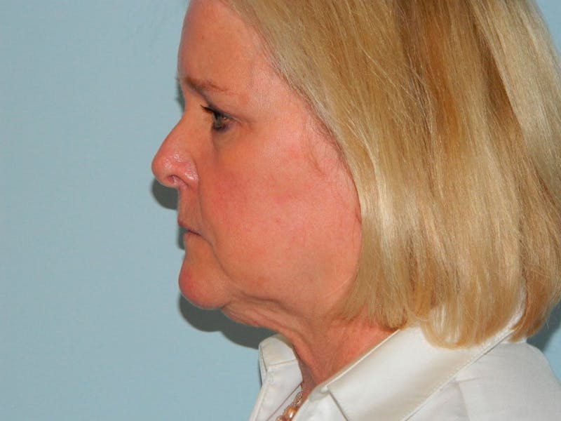 Facelift Before & After Gallery - Patient 133066501 - Image 5
