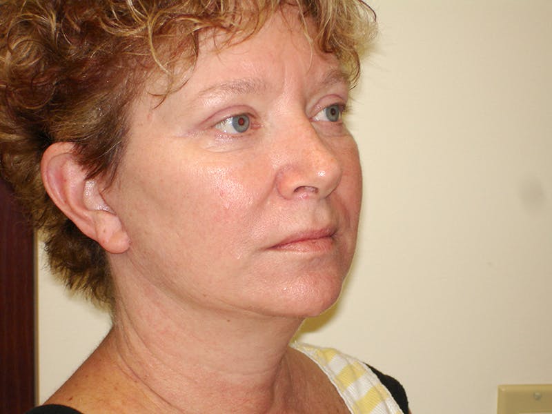 Blepharoplasty (Eyelid Lift) Before & After Gallery - Patient 133066498 - Image 4