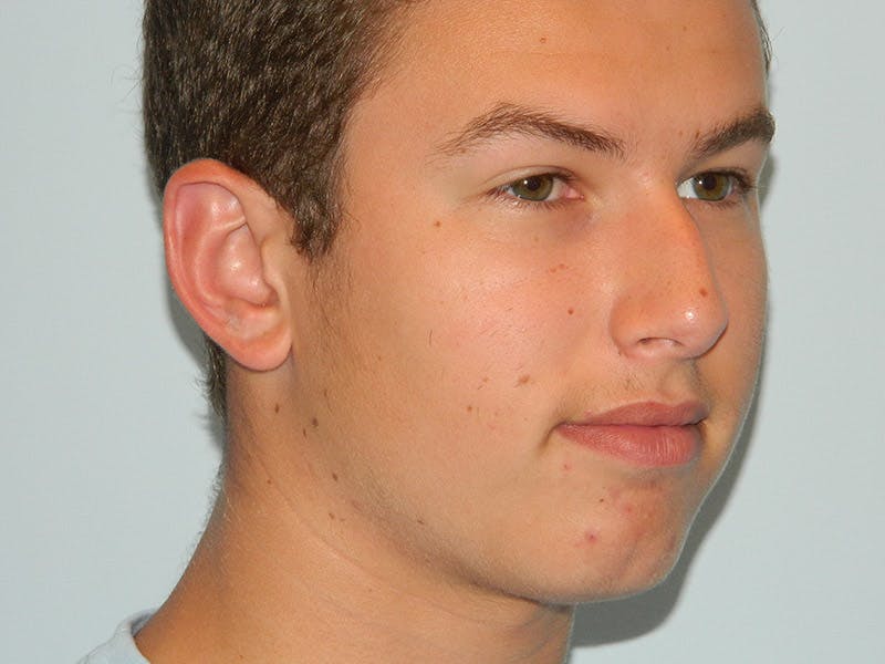 Chin Augmentation Before & After Gallery - Patient 133066499 - Image 5